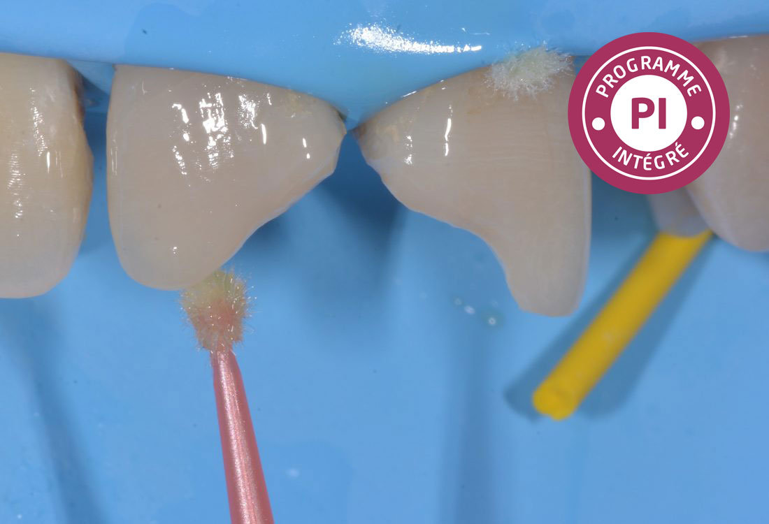 La dentisterie adhésive une évidence au quotidien dental Formation